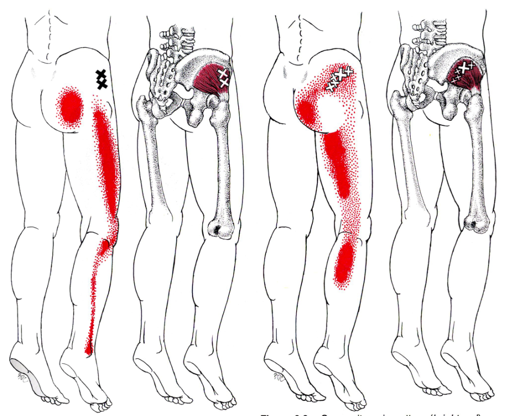 trigger points dry needling fysio amersfoort 